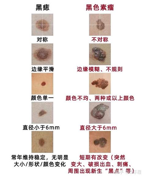 生黑痣|黑痣形成的原因是什么？它对人体有什么危害么？推不推荐把痣去。